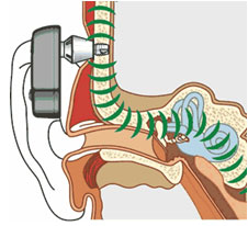 Слуховые аппараты костного звукопроведения